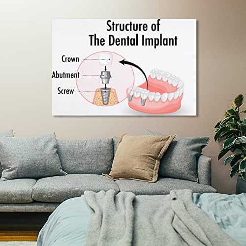 BLUDUG Инфографика Човек в структурата на Зъбен имплант Плакати Стоматологичен Плакат Платно Картина Стенен Художествен